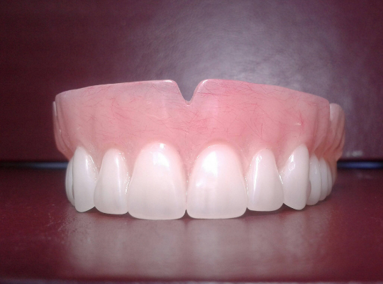 zUpper acrylic denture, wax try-in, horseshoe palate, shipping (x2), new upper impression